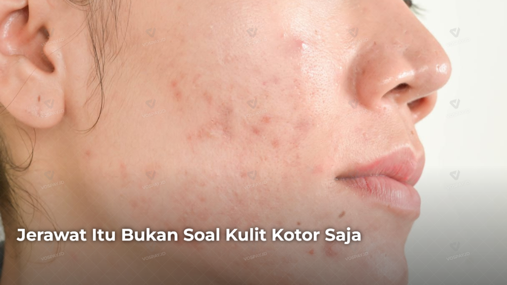 jerawat-itu-bukan-soal-kulit-kotor-saja